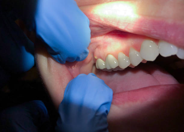 Best Tooth Infection Emergency Dentist  in Cottage Grove, WI